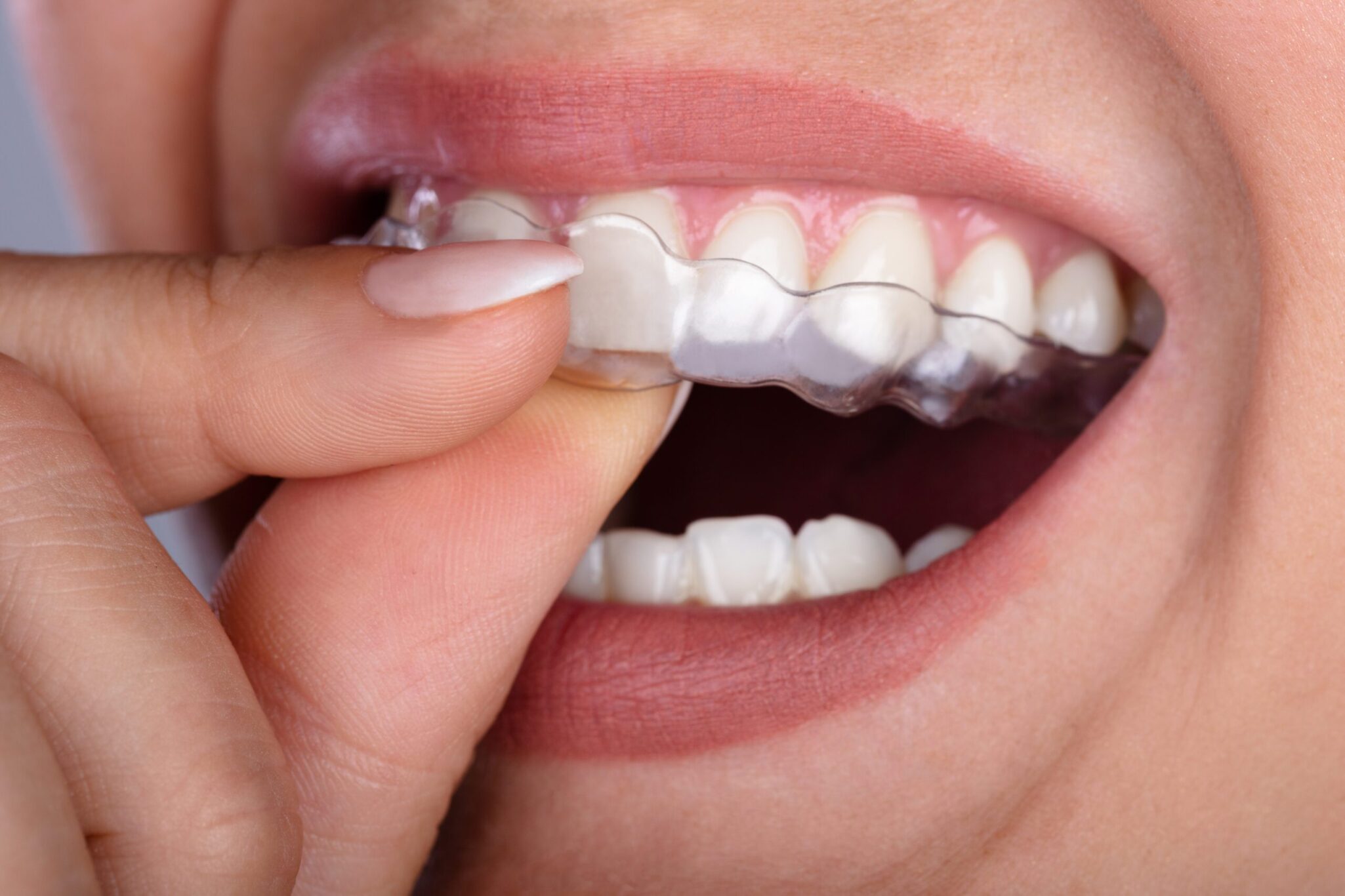 clear aligners Pittsburgh