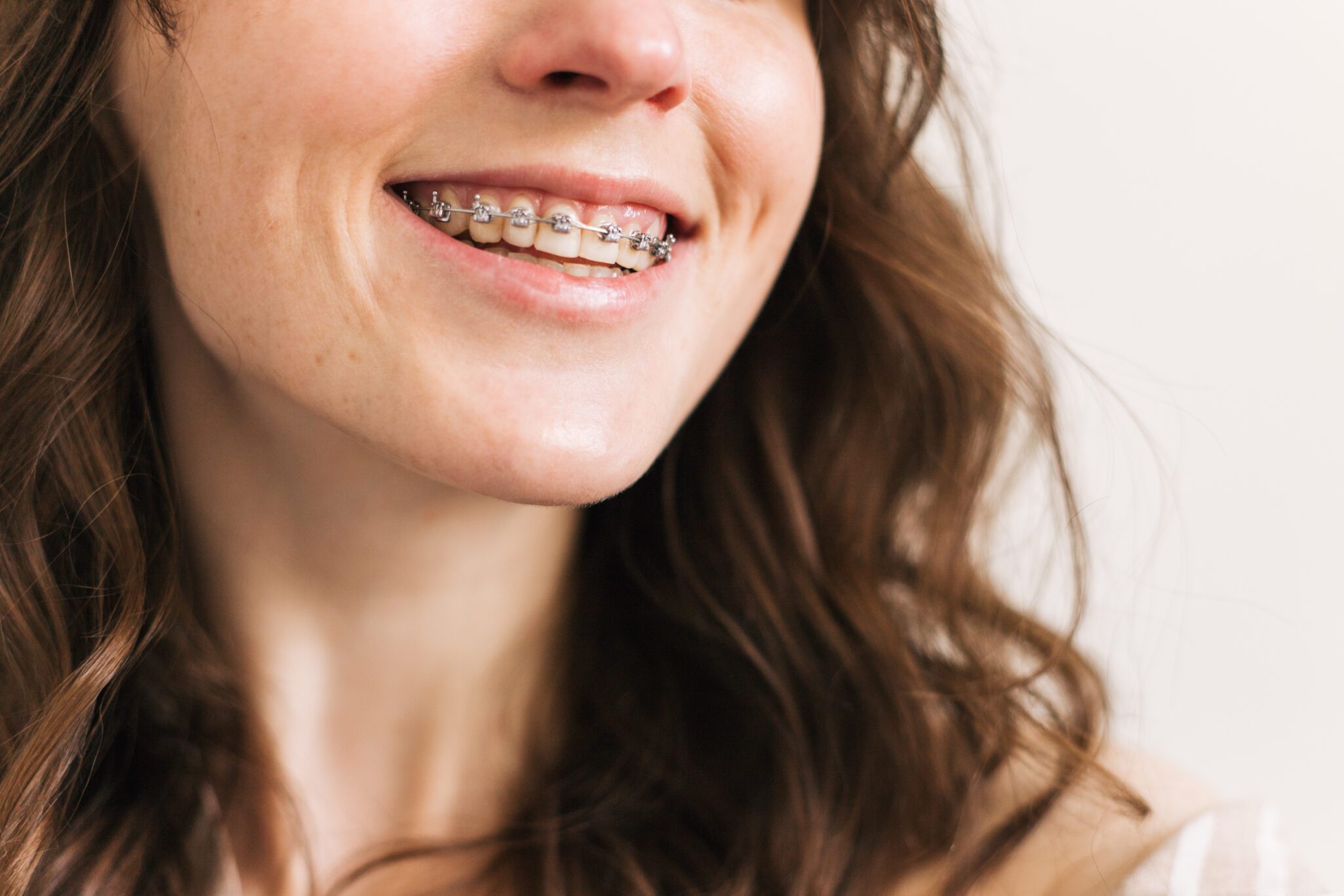 traditional braces